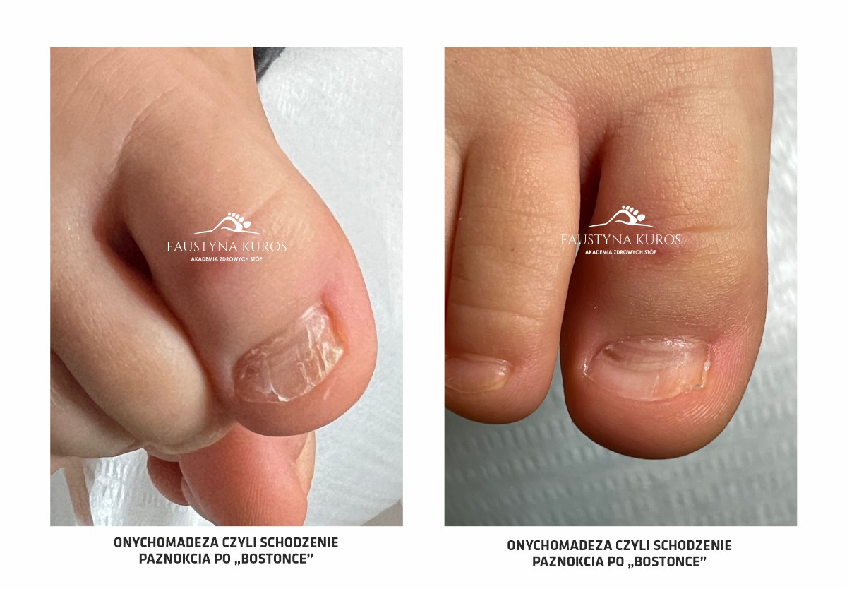 schodzenie paznokcia u dziecka