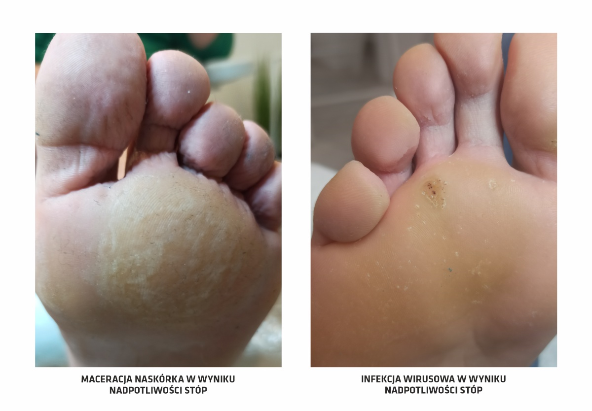 Obraz ukazuje macerację naskórka stopy oraz infekcję wirusową, powstałe w wyniku nadpotliwości stóp.